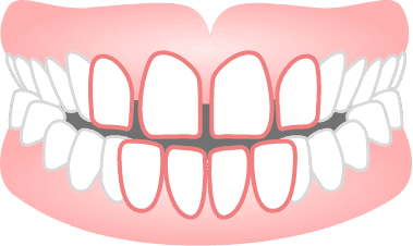 すきっ歯(空隙歯列)